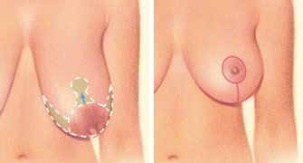 breast-reduction-1